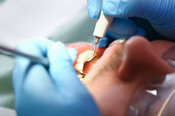 Best Dentist for Tooth Abscess  in Ashburn, GA